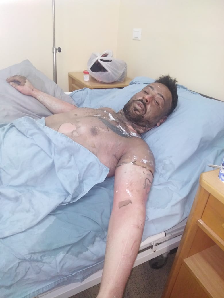 محمد بدر عتمه في مستشفى مرجعيون بعد تعرضه للحروق في جسمه ووجهه