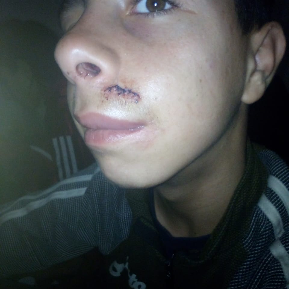 من آثار التعدي على أحد أبناء تلك الأسرة السورية على وجهه