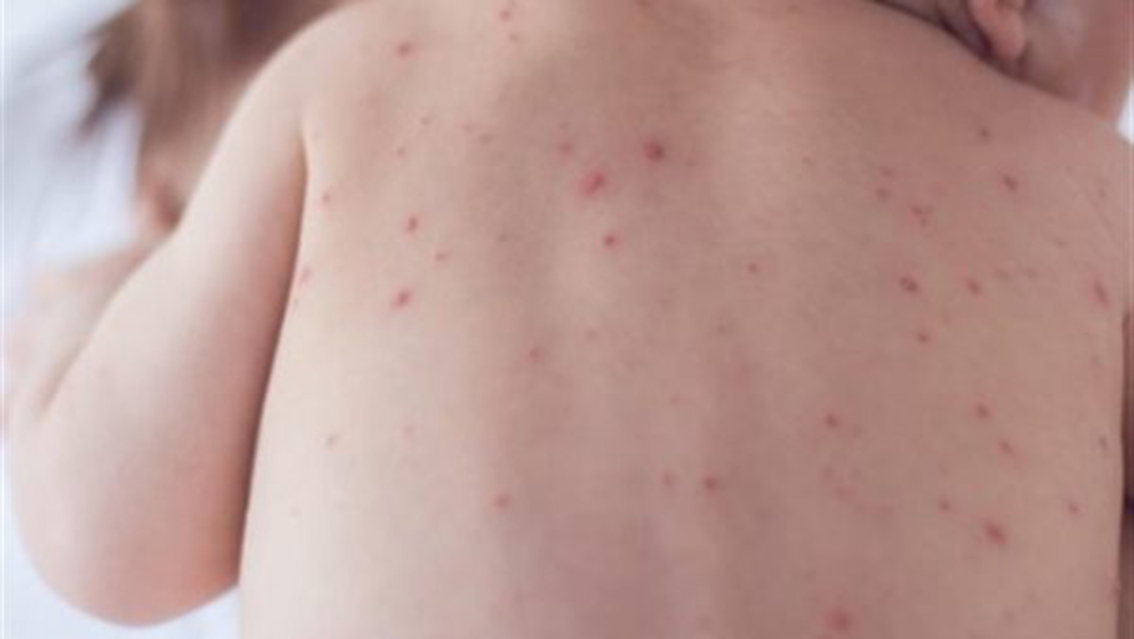 حمو النيل يظهر على هيئة حبوب صغيرة باللون الأحمر ينتج عنه حكّة أحيانًا