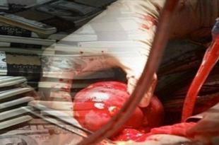 إعمار سوريا.. من يوقف مهنة تجارة الأعضاء؟