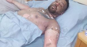 تعرض شاب سوري في الخيام لحروق عديدة في جسمه ووجهه